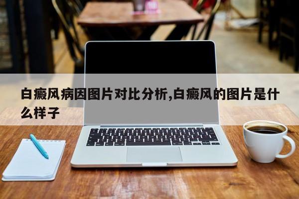 白癜风病因图片对比分析,白癜风的图片是什么样子
