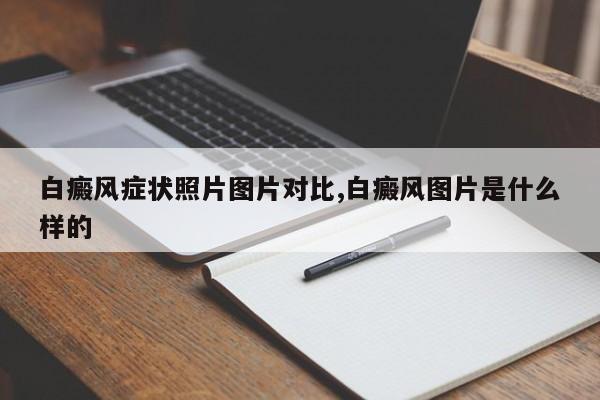 白癜风症状照片图片对比,白癜风图片是什么样的