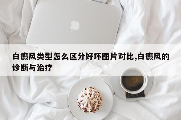 白癜风类型怎么区分好坏图片对比,白癜风的诊断与治疗