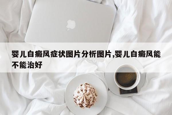 婴儿白癜风症状图片分析图片,婴儿白癜风能不能治好