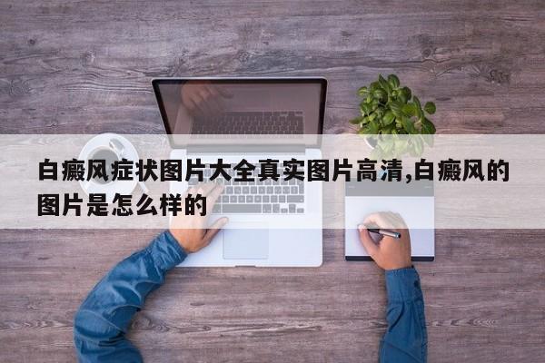 白癜风症状图片大全真实图片高清,白癜风的图片是怎么样的