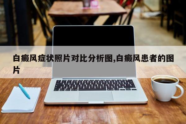白癜风症状照片对比分析图,白癜风患者的图片