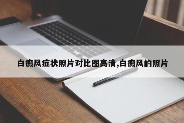 白癜风症状照片对比图高清,白癜风的照片
